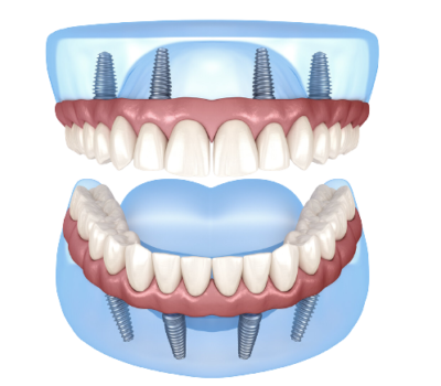 All-on-fours-Dental-removebg-preview